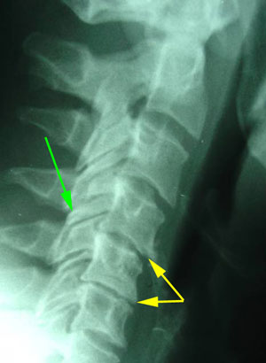 disc degeneration treated at Medical Spine and Sports Injury and Rehab Centers