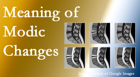 Medical Spine and Sports Injury and Rehab Centers sees many back pain and neck pain patients who bring their MRIs with them to the office. Modic changes are often seen. 