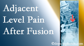 Medical Spine and Sports Injury and Rehab Centers offers relieving care non-surgically to back pain patients suffering with adjacent level pain after spinal fusion surgery.
