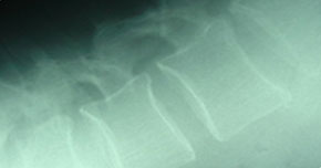 osteoporosis