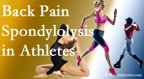 Spine & Sports Rehab Center treats athletes of all levels and all ages who have back pain using spinal manipulation, nutrition and specific exercise.