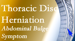 Medical Spine and Sports Injury and Rehab Centers cares for thoracic disc herniation that for some patients prompts abdominal pain.