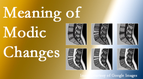 Medical Spine and Sports Injury and Rehab Centers sees many back pain and neck pain patients who bring their MRIs with them to the office. Modic changes are often seen.