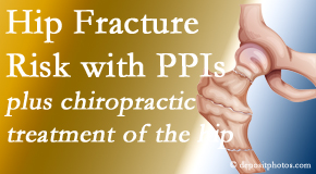 Spine & Sports Rehab Center shares new research describing higher risk of hip fracture with proton pump inhibitor use. 
