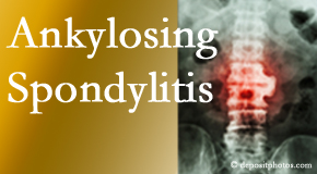 Ankylosing spondylitis is gently cared for by your Baton Rouge chiropractor.