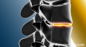 Baton Rouge degenerative spinal changes 