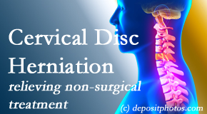 Medical Spine and Sports Injury and Rehab Centers offers the Cox® Technic spinal manipulation to treat cervical radiculopathy and avert surgery.