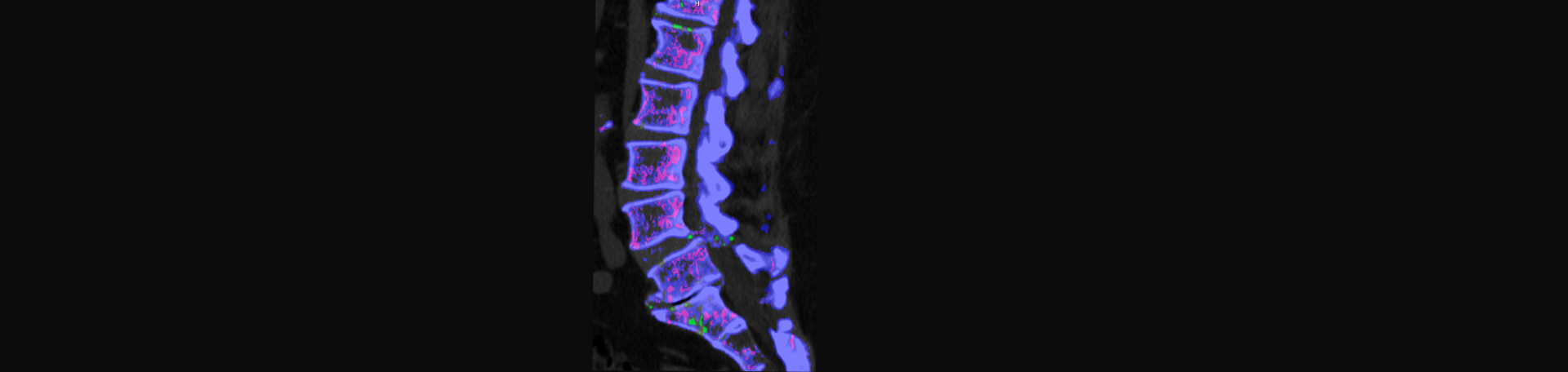 Medical Spine and Sports Injury and Rehab Centers is aware that inflammatory spinal gout is a differential diagnosis to consider for patients who present with back pain and other spine related symptoms.