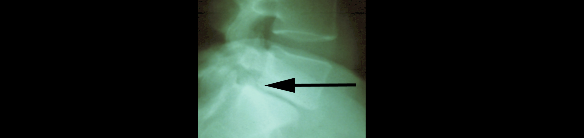 Baton Rouge spondylolisthesis