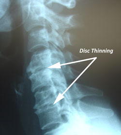 disc degeneration
