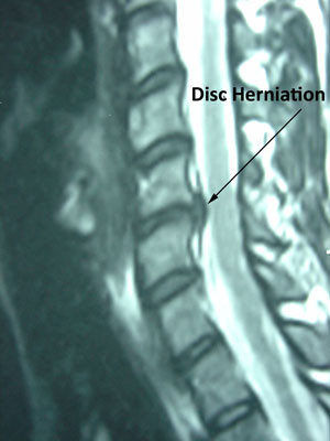 disc herniation in cervical spine