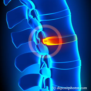 image of lumbar Baton Rouge disc herniation