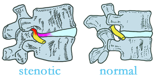 Baton Rouge  stenotic and normal spinal discs