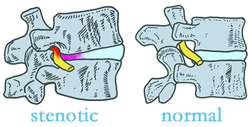 Baton Rouge stenotic and normal spinal discs